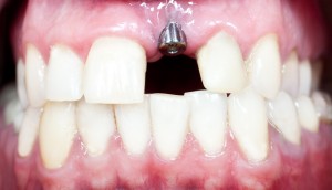 Dental Implants in Rochester Hills, MI