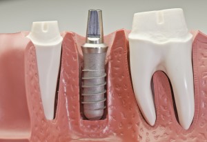 Implant Dentistry in Rochester Hills, MI